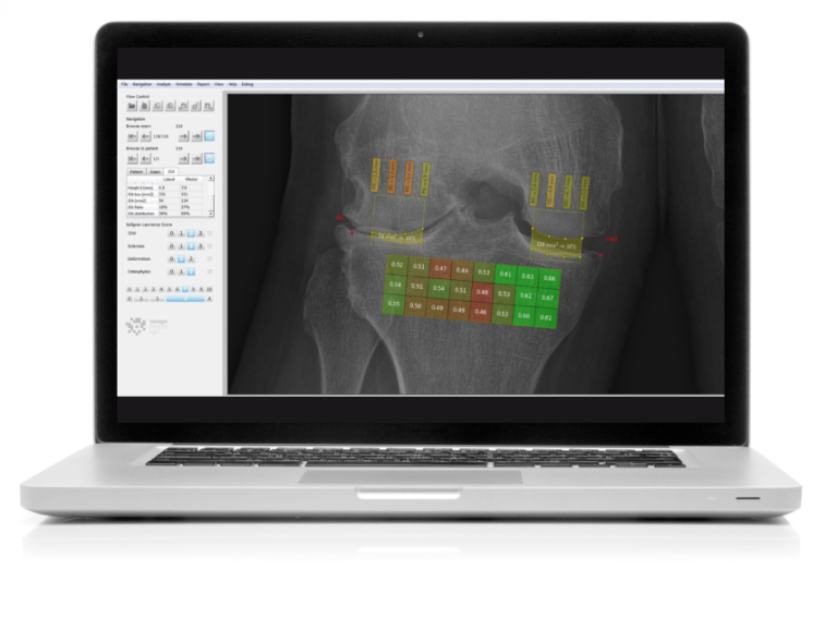 Braincon Technologies - BMA Software - Bone Micro Architecture Analysis